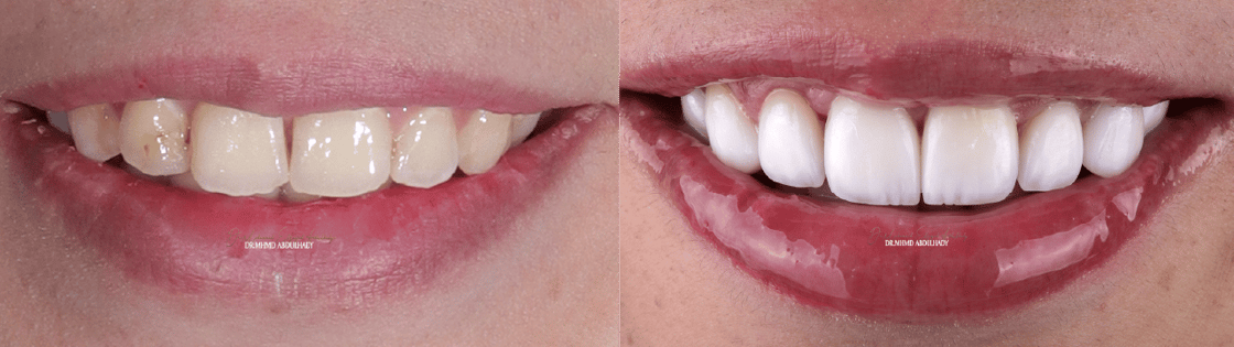 Esthetic & Functional Veneers - The Medit Times - Medit