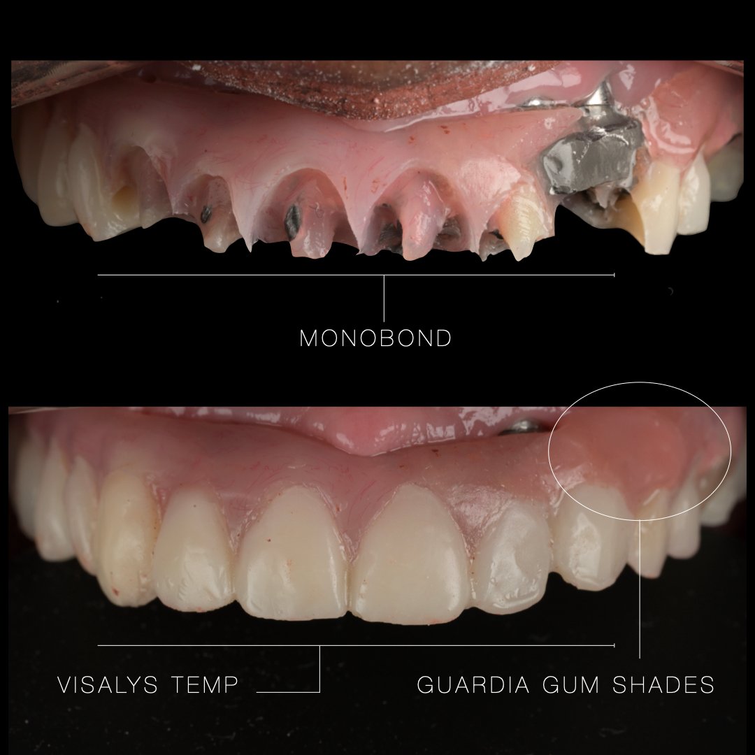 Medit - Hybrid Emergency Fix - Broken Acrylic Maxillary Hybrid