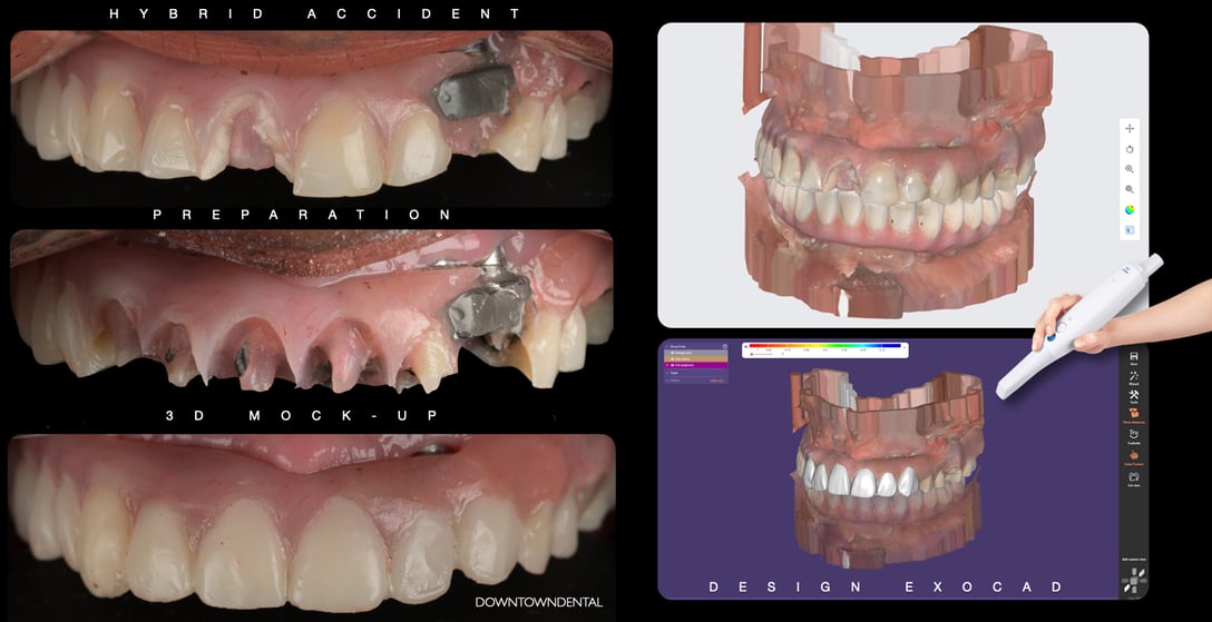 Medit - Hybrid Emergency Fix - Broken Acrylic Maxillary Hybrid