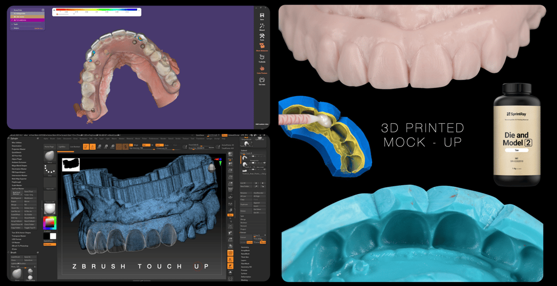 Medit - Hybrid Emergency Fix - Broken Acrylic Maxillary Hybrid